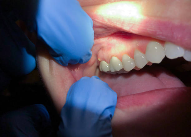 Best Emergency Dental Care for Broken or Chipped Teeth in Richardson, TX