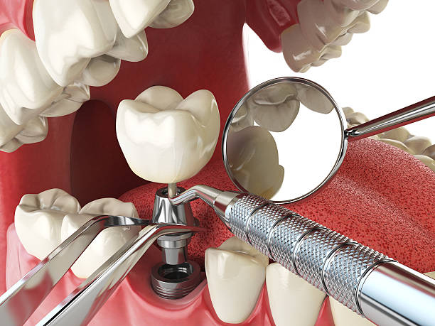 Best Emergency Root Canal Treatment in Richardson, TX
